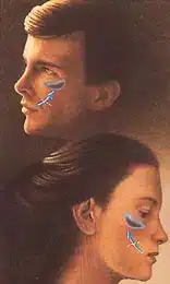 facial implant 3.jpg