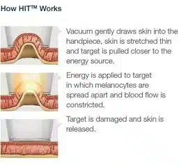 laser hair removal11.jpg