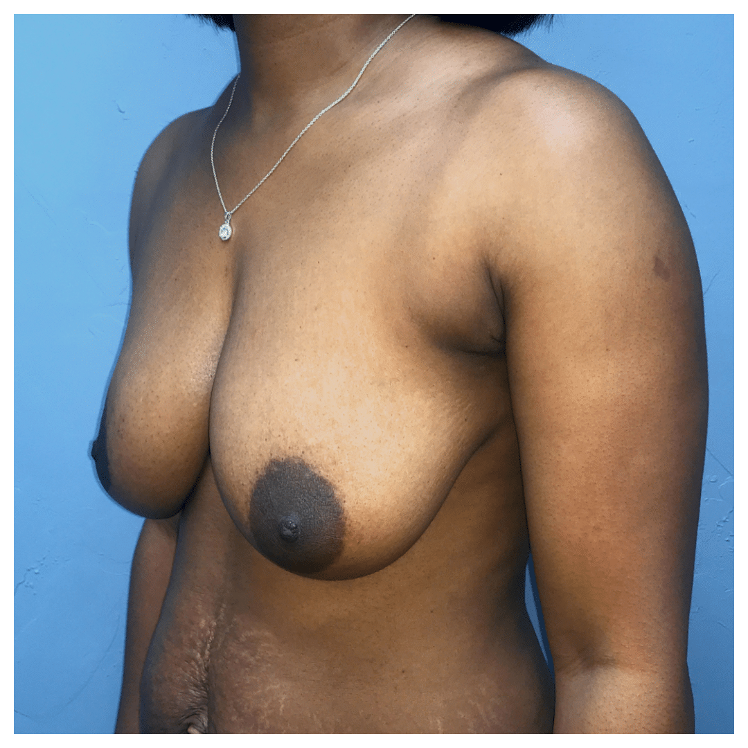 Before Image: Breast Lift with Auto-Augmentation #6901 - left-front-oblique