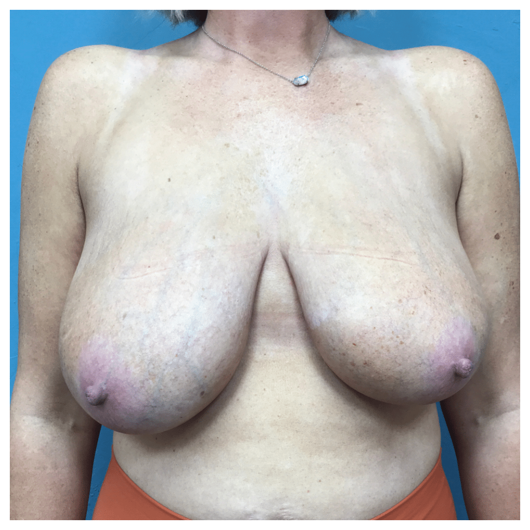Before Image: Breast Lift with Auto-Augmentation #6911 - front