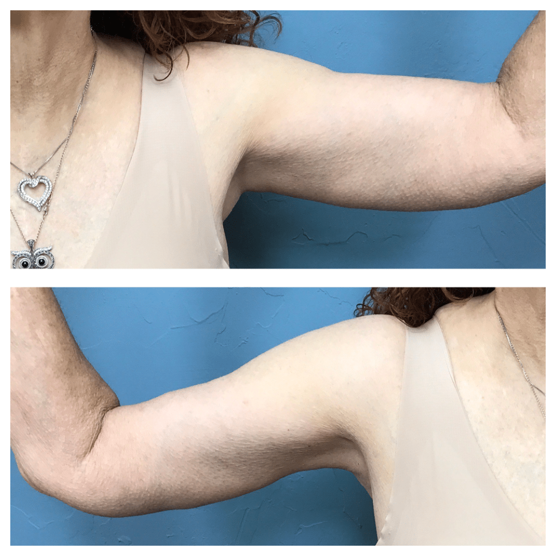 After Image: Arm Lift #6974 - front