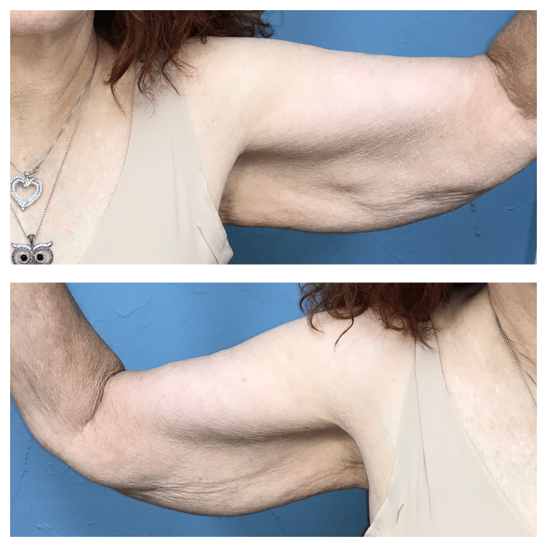 Before Image: Arm Lift #6974 - front