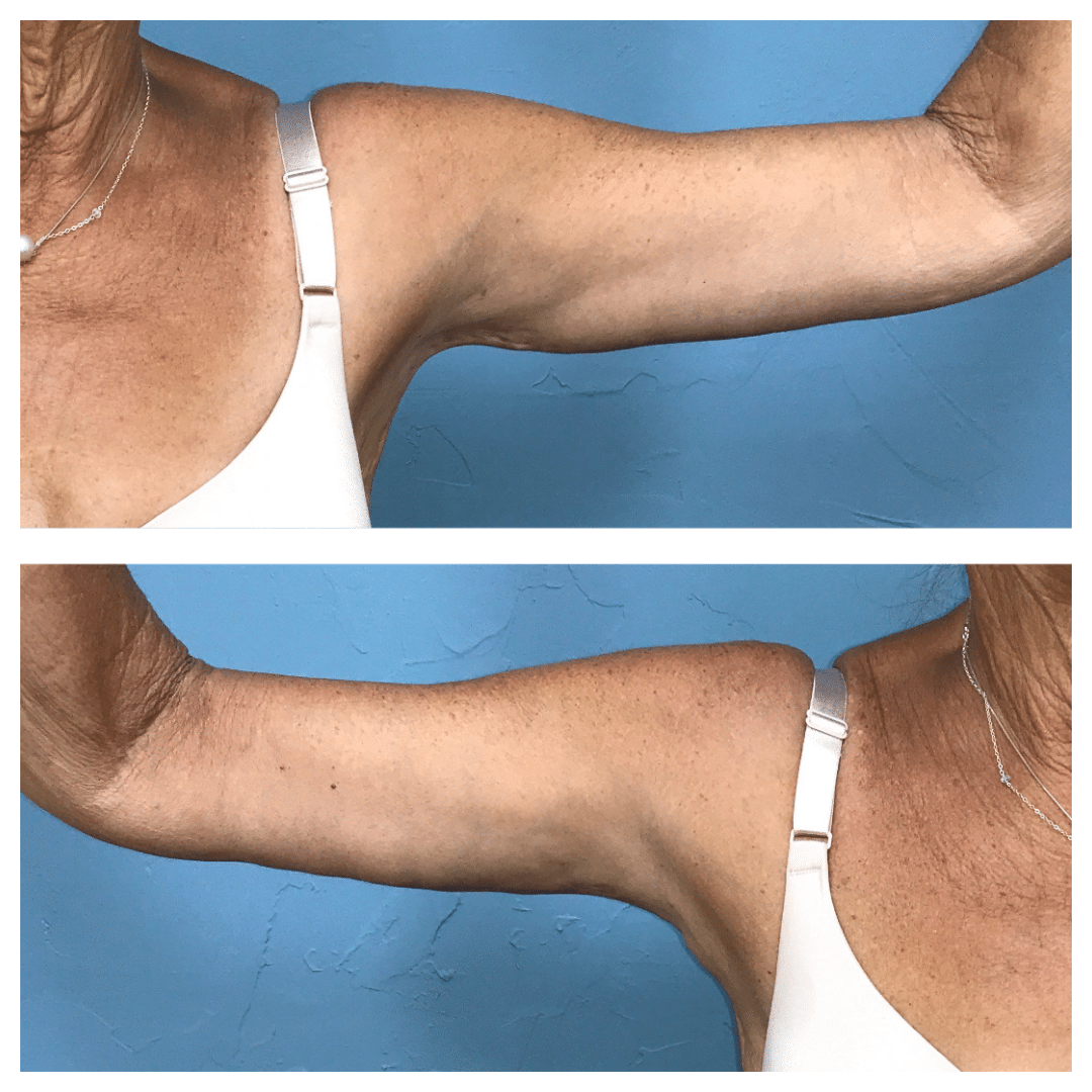 After Image: Arm Lift #6979 - front