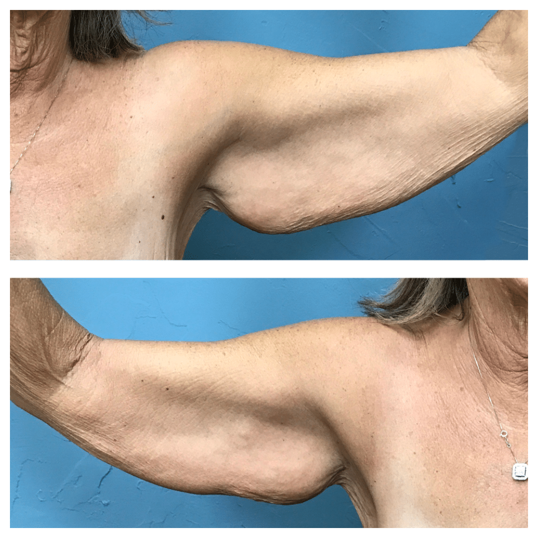 Before Image: Arm Lift #6979 - front